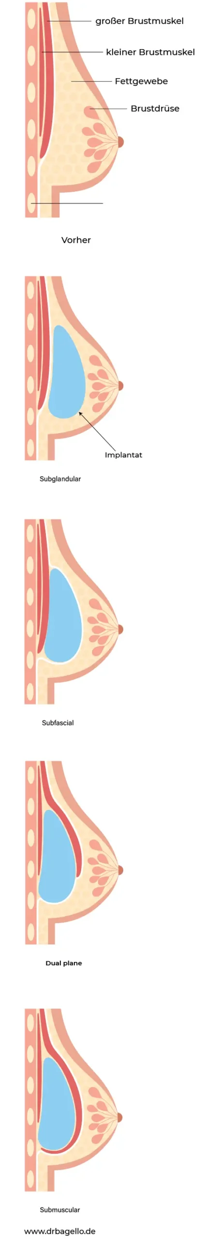 brusterklaerunghochformat